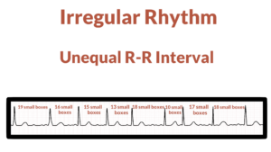 Interpreting ECG Strips – Nursing Unraveled