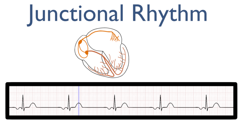 Juncitonal Rhytm Junctional Rhythm – Nursing Unraveled